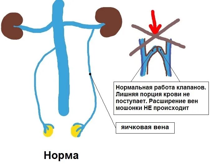 Расширение семенной вены. Варикоз вен семенного канатика. Варикозное расширение вен семенного канатика яичка.. Левая яичковая Вена впадает в.