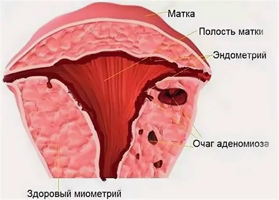 Диффузное изменение яичников. Диффузное изменение яичников
