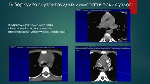 Туберкулезный лимфоузел