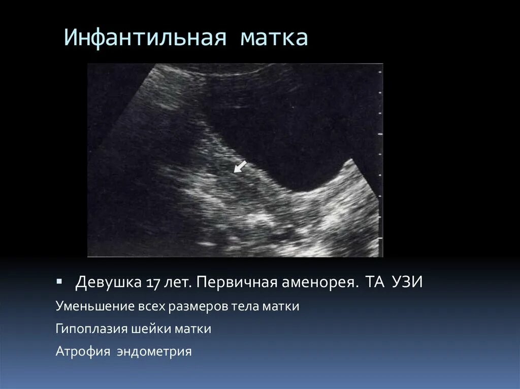 Гипоплазия матки классификация. Гипоплазия матки. Генитальный инфантилизм степени по узи. Инфантильная матка. Инфантильная матка.