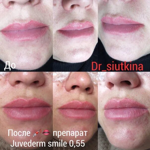 Губы после ювидерм. Juvederm smile 0.55. Juvederm Ultra smile – 0,55 мл - губы. Smile 0,5 Juvederm 0.55. Juvederm Ultra smile 0.5.