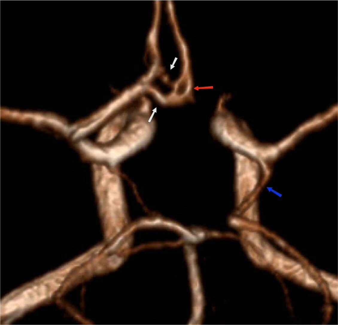 Гипоплазия позвоночной артерии кт. Аневризма позвоночной артерии кт. Гипоплазия р1 сегмента позвоночной артерии. Гипоплазия правой артерии мозга