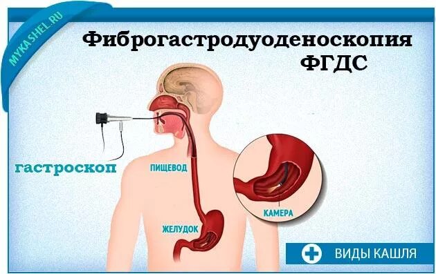 Кашель пищевода