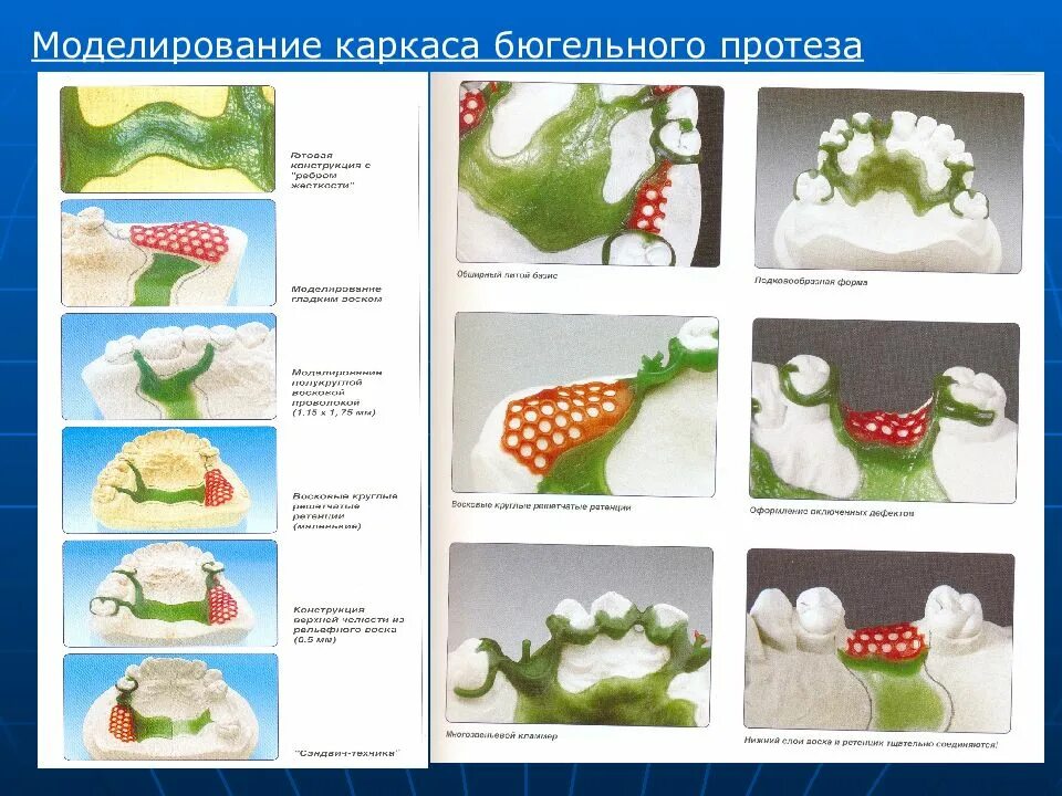 Моделирование каркаса бюгельного протеза. Этапы моделирования бюгельного протеза. Моделирование восковых композиций каркаса бюгельного протеза. Этапы моделирования каркаса бюгельного протеза. Этапы изготовления бюгельных