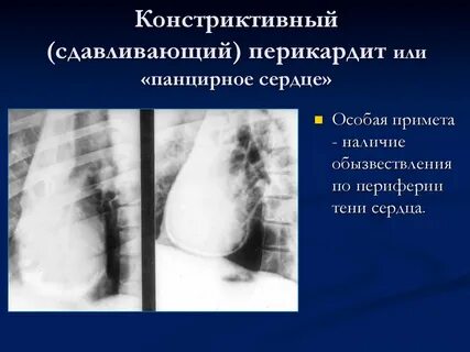Панцирное сердце