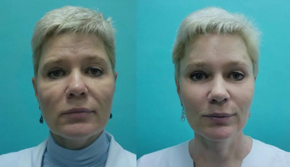 Малярные мешки под глазами лечение. Малярные мешки. малярные мешки на скулах. малярные мешки намскулах.
