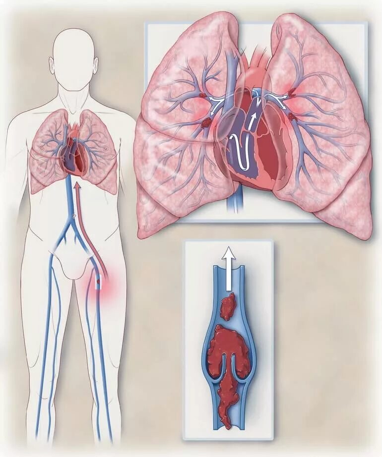 Тромбоэмболия легочной артерии. Тромб легочной артерии тромбоэмболия. Тромбоэмболия легочной артерри. Тромбоэмболия крупных ветвей легочной артерии. Тромболия легочной артерии