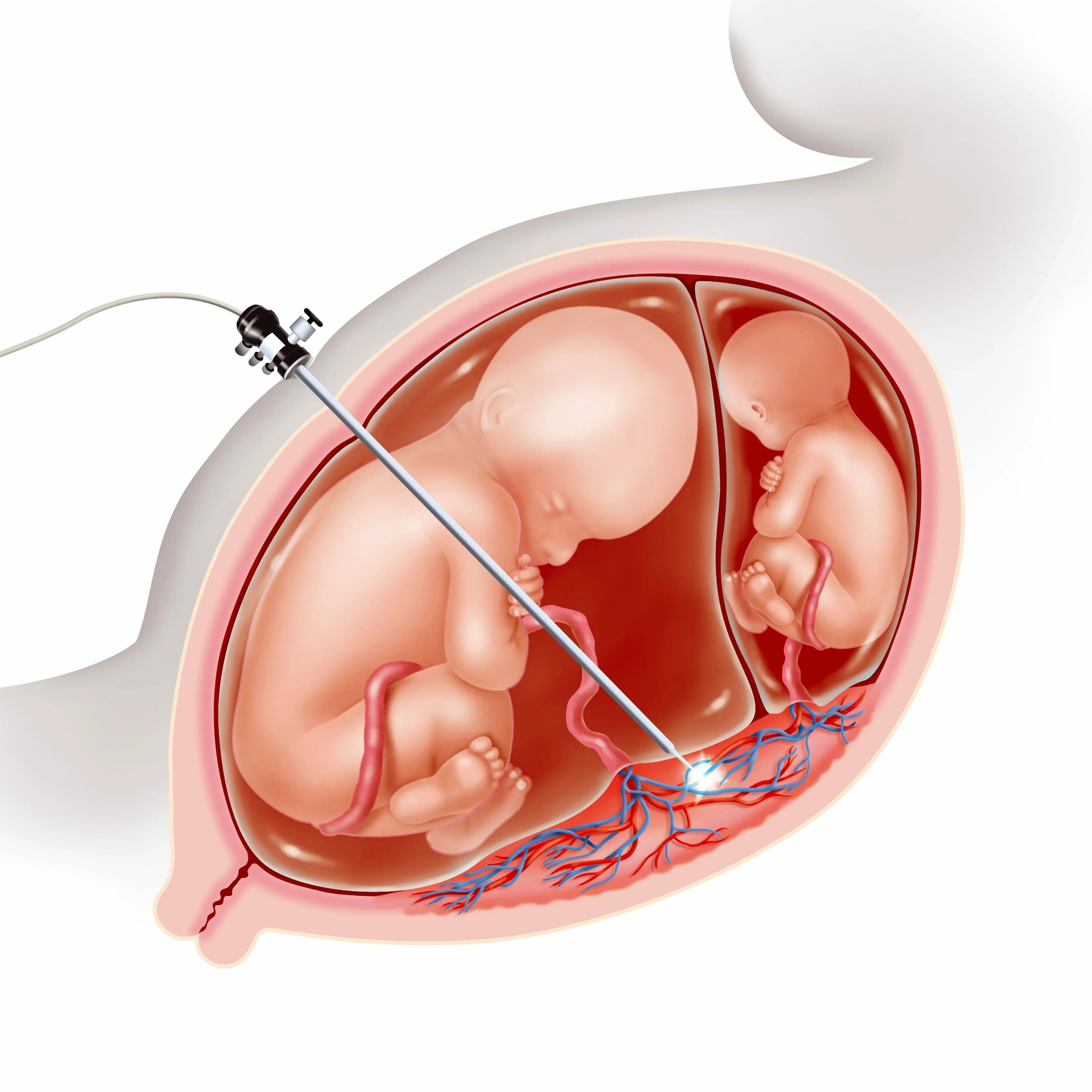Фето фетальный трансфузионный синдром. Внутриутробная операция. Внутриутробная операция плода. Фетальная хирургия