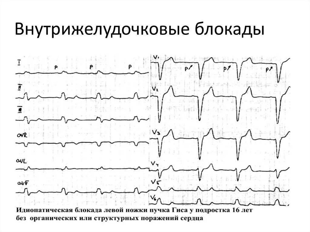 Блокада правого желудочка. Очаговая внутрижелудочковая блокада на ЭКГ. Блокада желудочков на ЭКГ. Блокада правого желудочка на ЭКГ. ЭКГ при желедочной блокаде.