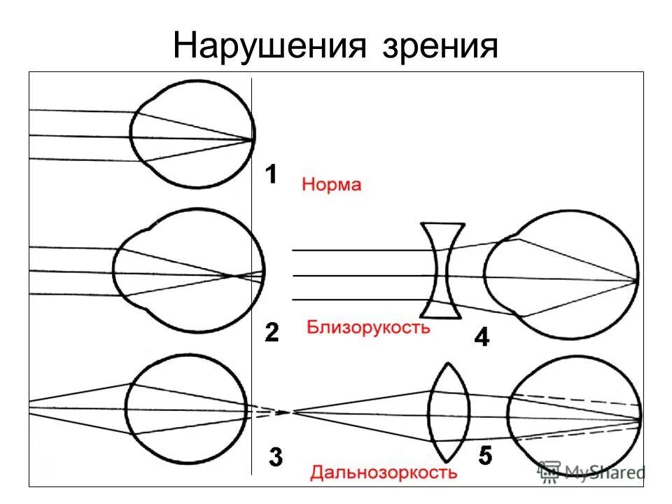 Нарушения функций зрения. Нарушение зрения близорукость дальнозоркость. Схема близорукости и дальнозоркости. Нарушение зрения схема. Миопия и гиперметропия схема.