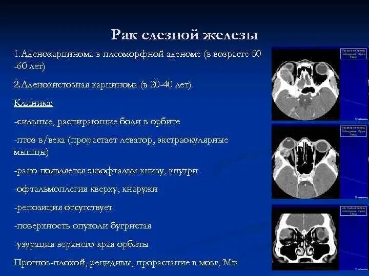 Опухоль слезной железы мрт. Плеоморфная аденома слезной железы. Опухоль слезной железы кт. Опухоли орбиты