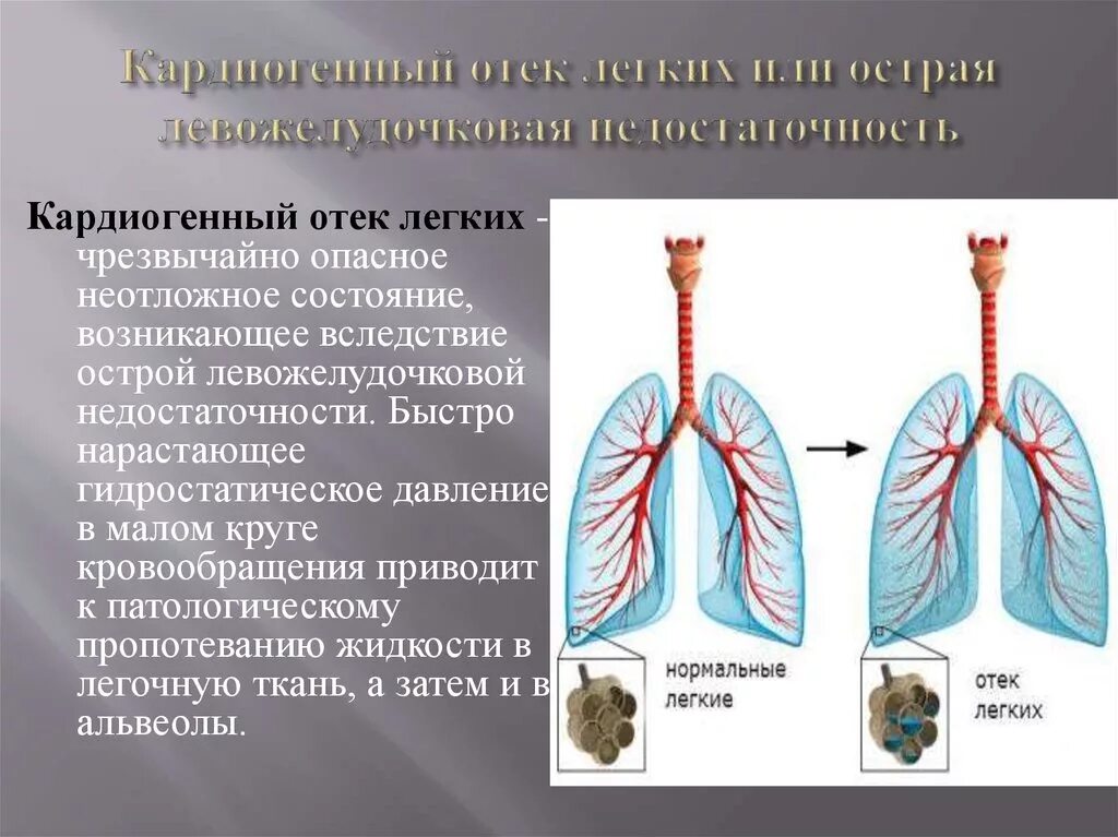 Механизм кардиогенного отека легких. Кардиогенный отек легких. Кардиагенный отёк лёгких. Кардиогенный отек легких патогенез. Отек легких виды