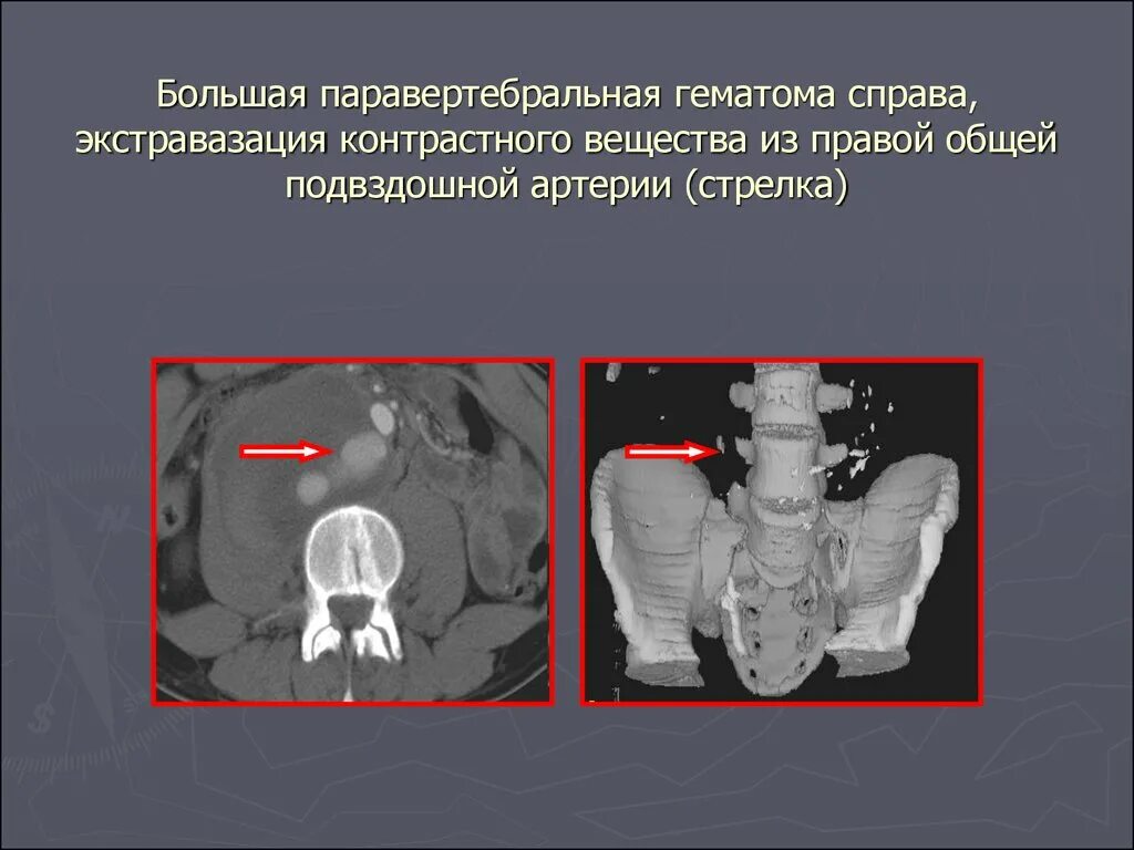 Что такое экстравазация. Экстравазация контраста кт. экстравазация контрастного вещества. экстравазация контрастного вещества при кт. правая подвздошная артерия на кт.