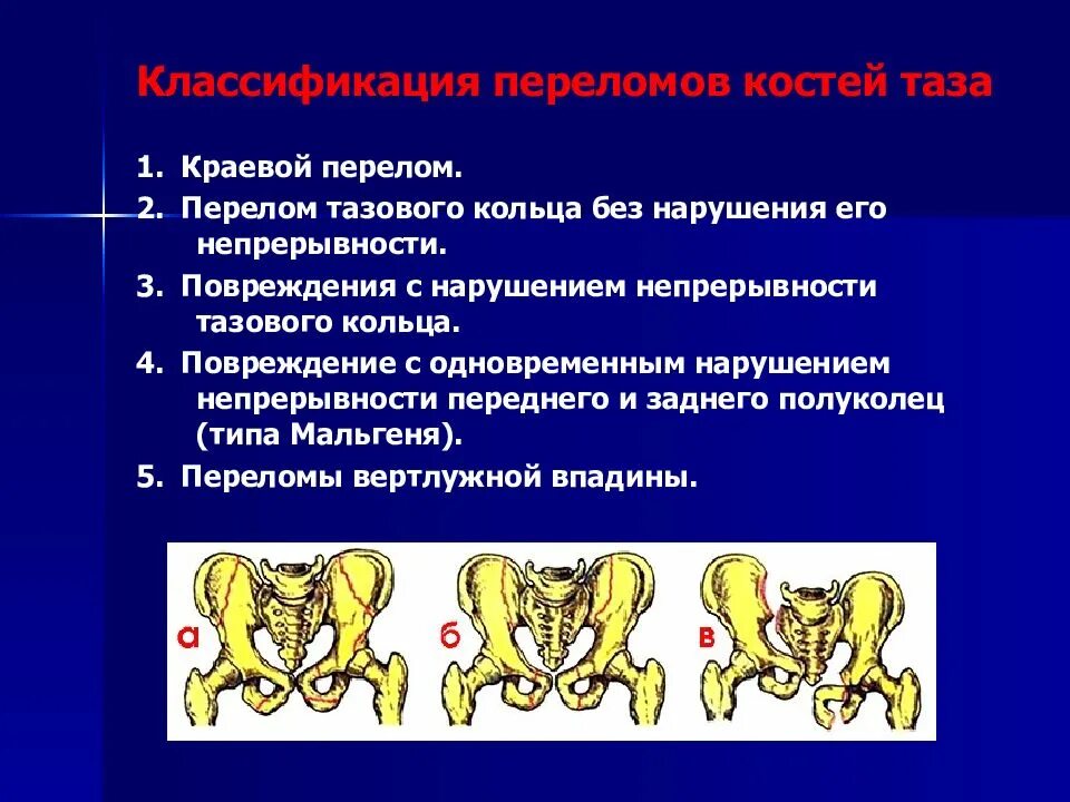 Травма костей таза классификация повреждений костей таза. Перелом таза с нарушением тазового кольца. Перелом лонной кости классификация. Классификация переломов костей таза (классификация а.в.Каплана)..