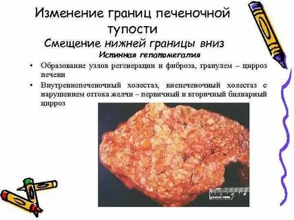 Границы тупости печени