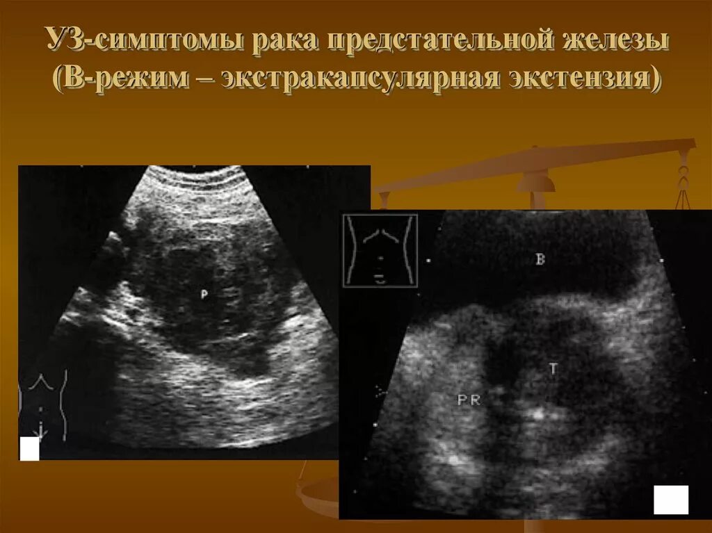 Простата рак симптомы лечение. Экстракапсулярная экстензия предстательной железы что это. Лучевая диагностика предстательной железы. Онкология простаты симптомы.