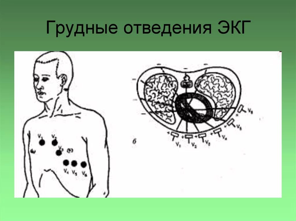 Наложение грудных электродов ЭКГ. Грудные отведения на ЭКГ электроды. Отведения ЭКГ грудные отведения. ЭКГ грудные отведения точки. Правые грудные отведения