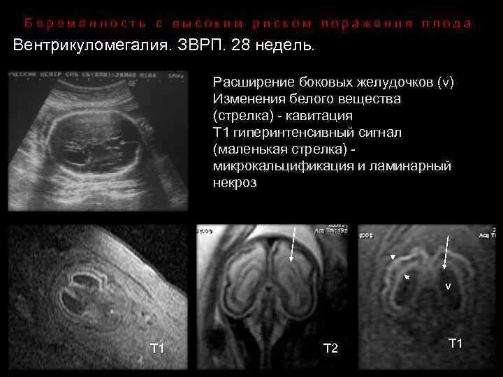 Вентиикуломегалия боковые желедочка. УЗИ желудочков головного мозга плода. Вентрикуломегалия норма желудочков. Задние рога боковых желудочков плода норма. Расширение боковых рогов