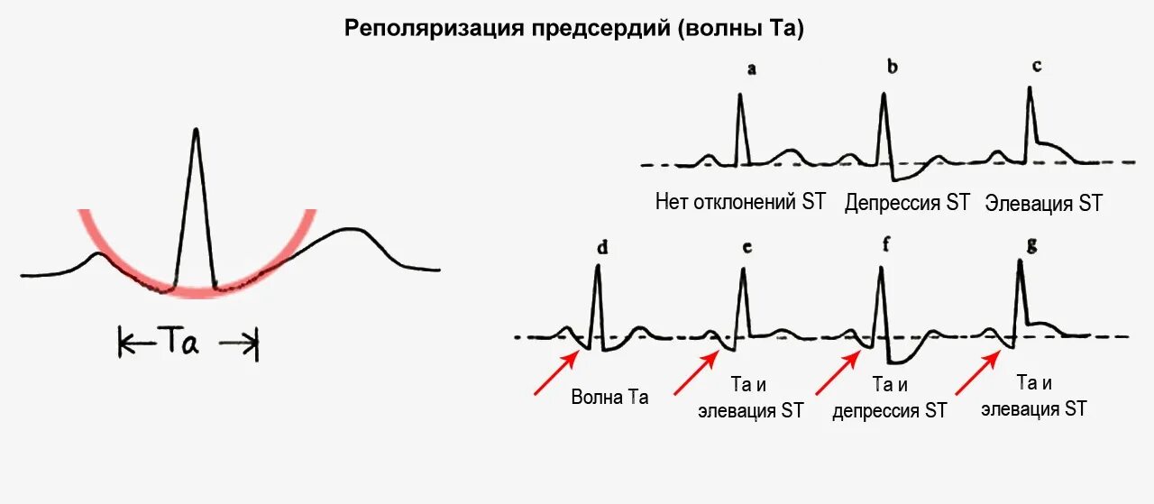 Нарушение реполяризации передне перегородочной области. Синдром ранней реполяризации предсердий ЭКГ. Реполяризация предсердий зубец. ЭКГ деполяризация и реполяризация. Реполяризация предсердий на ЭКГ.