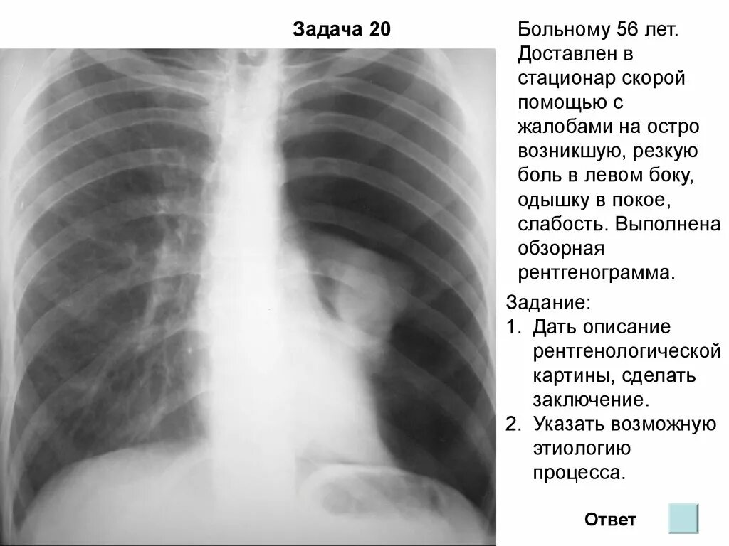 Признаки воздуха в легких. Спонтанный пневмоторакс туберкулез. Пневмоторакс при туберкулезе легких рентген. Пневмоторакс рентген признаки. Правосторонний пневмоторакс рентген.