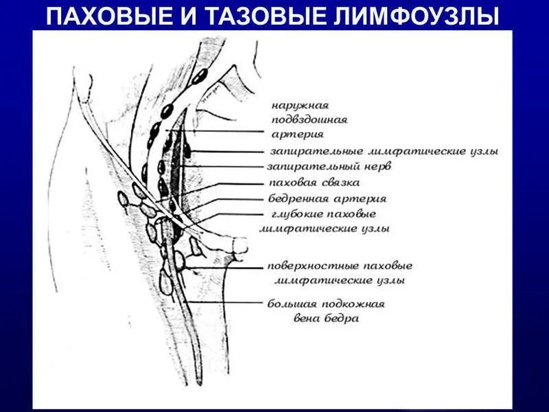 Лимфоузлы в паху у женщин причины. Паховые лимфоузлы расположение схема. лимфоузлы бедренной области. паховые лимфатические узлы схема. пахово бедренные лимфоузлы схема.