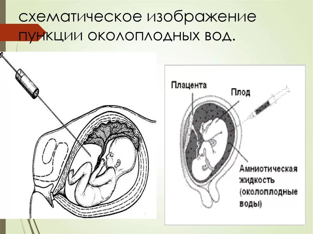 Трансабдоминальный амниоцентез показания. Исследование околоплодных вод амниоцентез. Трансвагинальный амниоцентез. Пренатальная диагностика амниоцентез. Анализ околоплодных вод