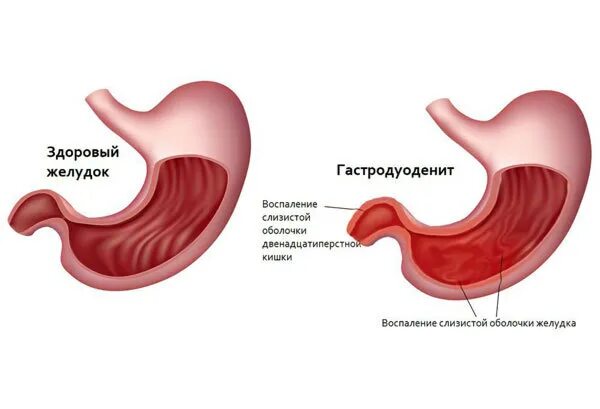 Может ли гастродуоденит. Гастродуоденит эрозивный бульбит. Хронический гастрит дуоденит. Хронический первичный гастродуоденит. Поверхностный гастродуоденит питание.