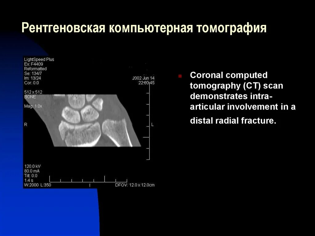 Что такое ркт. Рентгеновская компьютерная томография. Рентгеновская компьютерная томография костей. Рентгеновская компьютерная томография (РКТ). Рентгеновская компьютерная томография показания.