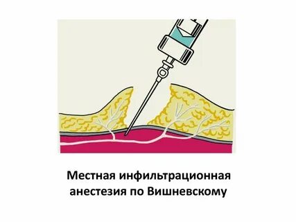 Инфильтрационная анестезия по вишневскому
