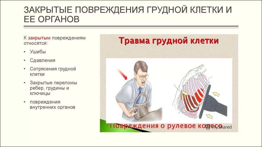 Сотрясение код. Признаки открытого повреждения грудной клетки. Травматические повреждения грудной клетки симптомы. Клинические симптомы ушиба грудной клетки. Признаки повреждения перелом грудной клетки.