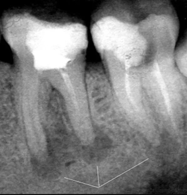 Фиброзный периодонтит. Периапекальные периодонтит. Периодонтит фиброзный гранулематозный гранулирующий. Хронический гранулирующий периодонтит рентген. Межкорневая гранулема.
