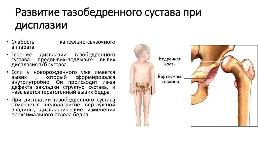 Тазобедренный артрит у ребенка. Дисплазия тазобедренного сустава у младенца 6. ДТБС У ребенка 1 год симптомы. Операция при дисплазии тазобедренных суставов у детей. Дисплазия тазобедренного сустава диагностика.