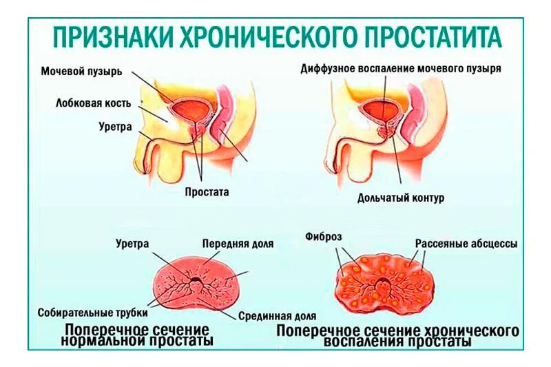 Виды простатита. Хронический простатит. Простатотис. Воспалительные заболевания предстательной железы.