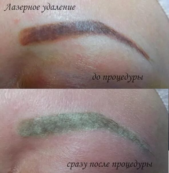 брови после лазера. после перманентного макияжа бровей красные брови. красные брови после удаления лазером. сведение татуажа бровей лазером. брови после удаления татуажа лазером.