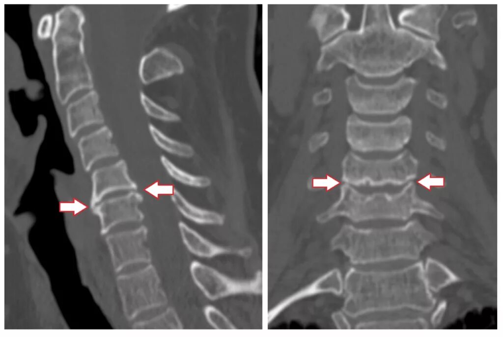 Спондилоартроз шейного отдела позвоночника рентген. Остеофиты шейного отдела позвоночника рентген. Спондилоартроз шейного отдела рентген. Спондилез на мрт позвоночника. Остеохондроз с7