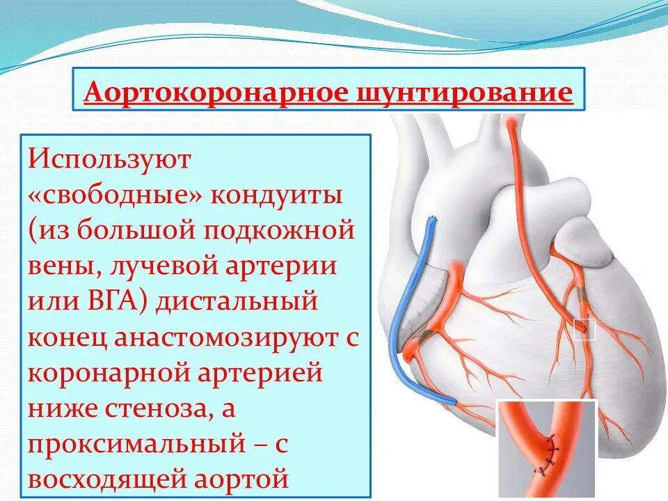 После операции коронарного шунтирования. Аортокоронарное шунтирование схема. Аортокоронарное шунтирование с искусственным кровообращением. Эндоваскулярная реваскуляризация миокарда. Аорта....аортокоронарное...шунтирование.