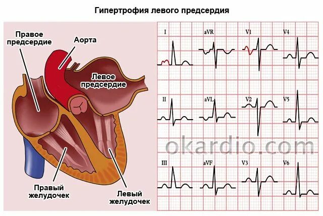 Гипертрофия предсердий на ЭКГ. Признаки гипертрофии левого предсердия на ЭКГ. Гипертрофия правого предсердия на ЭКГ. Дилатация правого предсердия ЭКГ. Левое предсердие увеличено