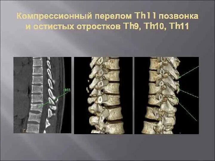 Компрессионный перелом тела th1 позвонка 12. Компрессионный перелом тела позвоночника th7. Компрессионный перелом позвоночника т11. Компрессионный перелом th5 позвонка. Компрессионный перелом тела 1 1