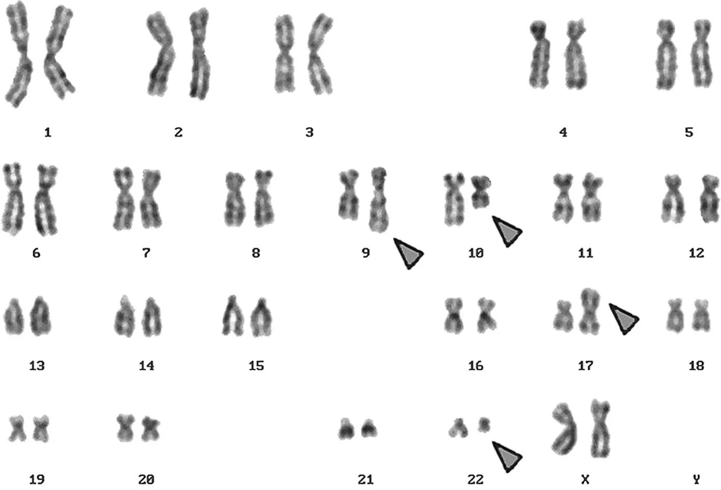 Хромосомы краба. Транслокация хромосом кариотип. Филадельфийская хромосома кариотип. Хронический миелолейкоз кариотип. Кариотип Вики.