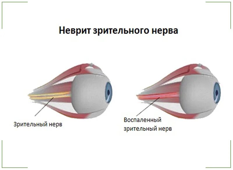 Неврит зрительного нерва классификация. Клиника поражения зрительного нерва. Симптомы при неврите зрительного нерва. Неврит зрительного нерва интрабульбарный папиллит.