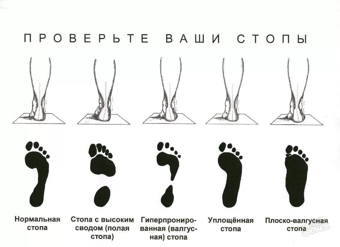 Правильная форма члена. Отпечаток стопы 3 степени плоскостопия. Статическая деформация стопы, плоскостопие. Плоскостопие 3 степени след. Нормальный свод стопы и плоскостопие.