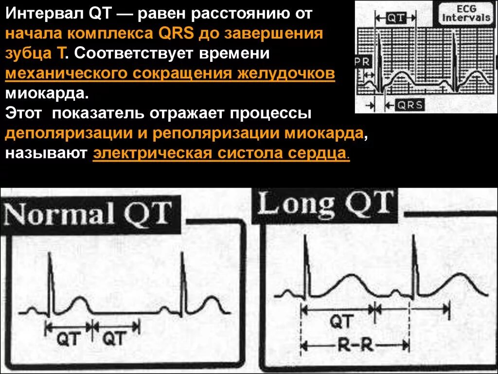 Нарушение реполяризации отделов. Интервал qt на ЭКГ. Деполяризация миокарда. Деполяризация желудочков и комплекс QRS. Комплекс QRS отражает процесс:.
