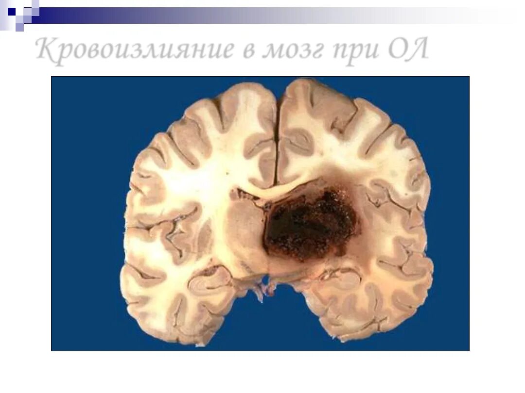 Размягчение головного мозга. Геморрагический инсульт макропрепарат. Ишемический инфаркт мозга патанатомия. Ишемический инсульт патанатомия. Патоморфология ишемического инсульта.