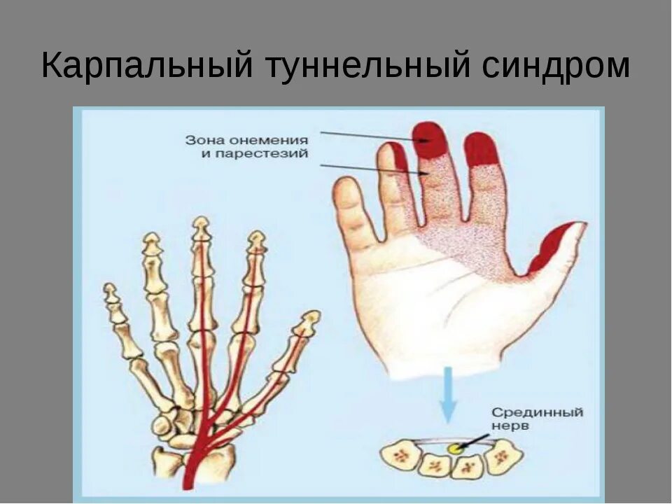 Туннельный синдром лучезапястного сустава. Туннельный карпальный синдром руки. Карпальный туннельный синдром кисти. Синдром запястного (карпального) канала. Синдром карпального канала мкб 10