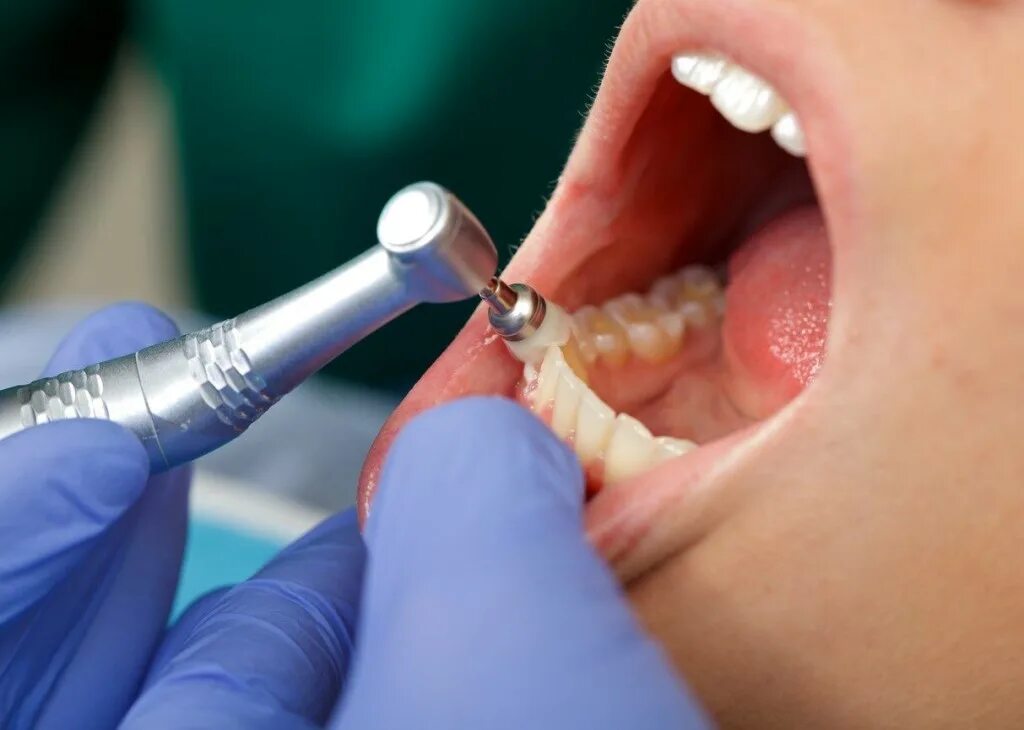Профессиональная чистка зубов у стоматолога