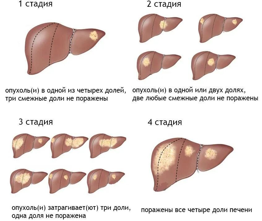 Гемангиома печени причины и лечение