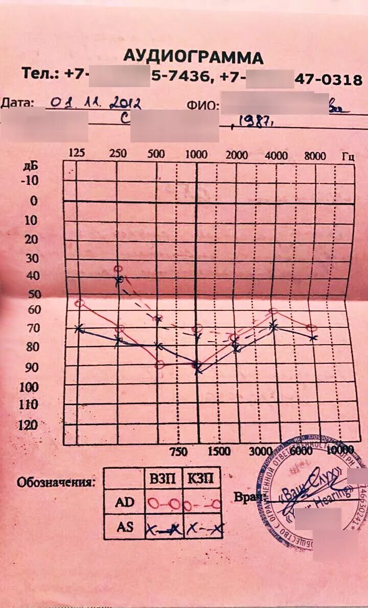 Аудиограмма норма. Аудиометрия слуха норма таблица. Аудиограмма здорового человека норма. Аудиограмма 1 степени тугоухости. Тугоухость расшифровка аудиограммы.