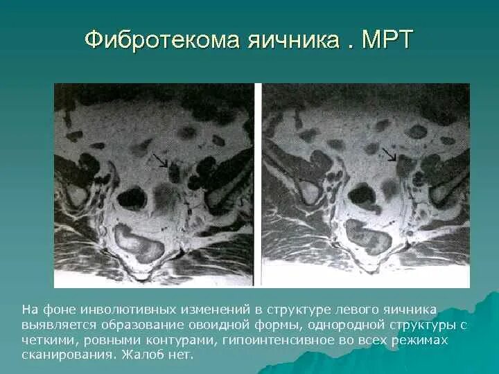 Инволютивные изменения яичников что это. Аденофиброма яичника УЗИ. Текома фиброма яичника мрт.