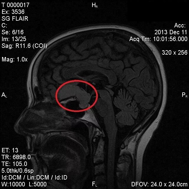 Образование головного мозга код. Менингиома передней черепной ямки. Презентация нейроонкология. Менингиомы эпидемиология.