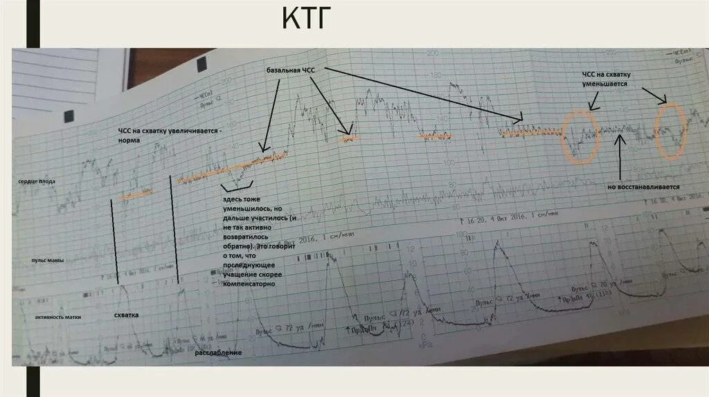 Схватки видел. КТГ при беременности расшифровка при схватках. Расшифровка КТГ со схватка и. Схватки на КТГ. Как выглядят схватки на КТГ.